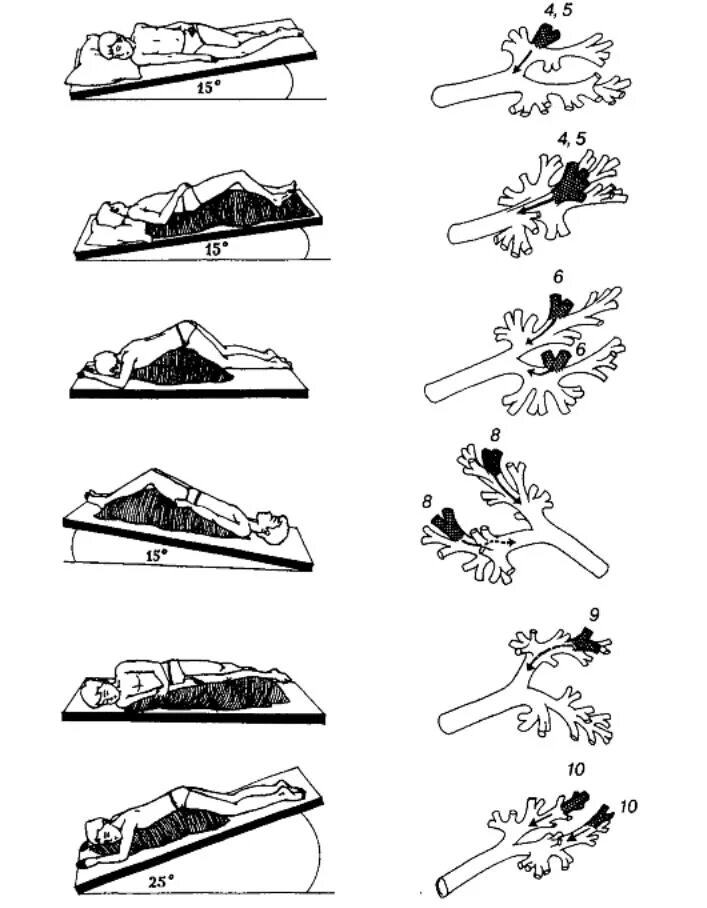 Дренажная гимнастика для отхождения мокроты. Дренажные положения для отхождения мокроты. Гимнастика для отхождения мокроты при пневмонии. Дринадное положение для от хождения макроты.