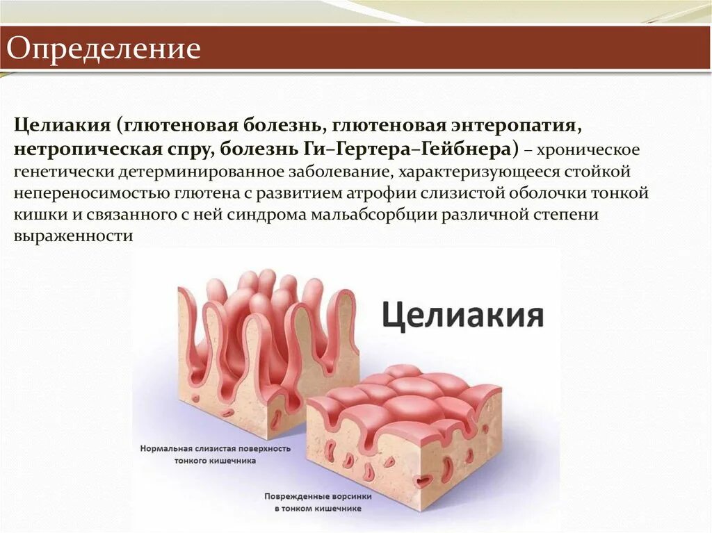 Клинические симптомы целиакии. Глютеновая энтеропатия, целиакия.. Целиакия клинические рекомендации. Целиакия что это за заболевание у взрослых