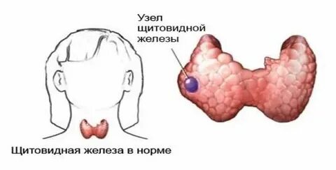 Узел щитовидки без операции