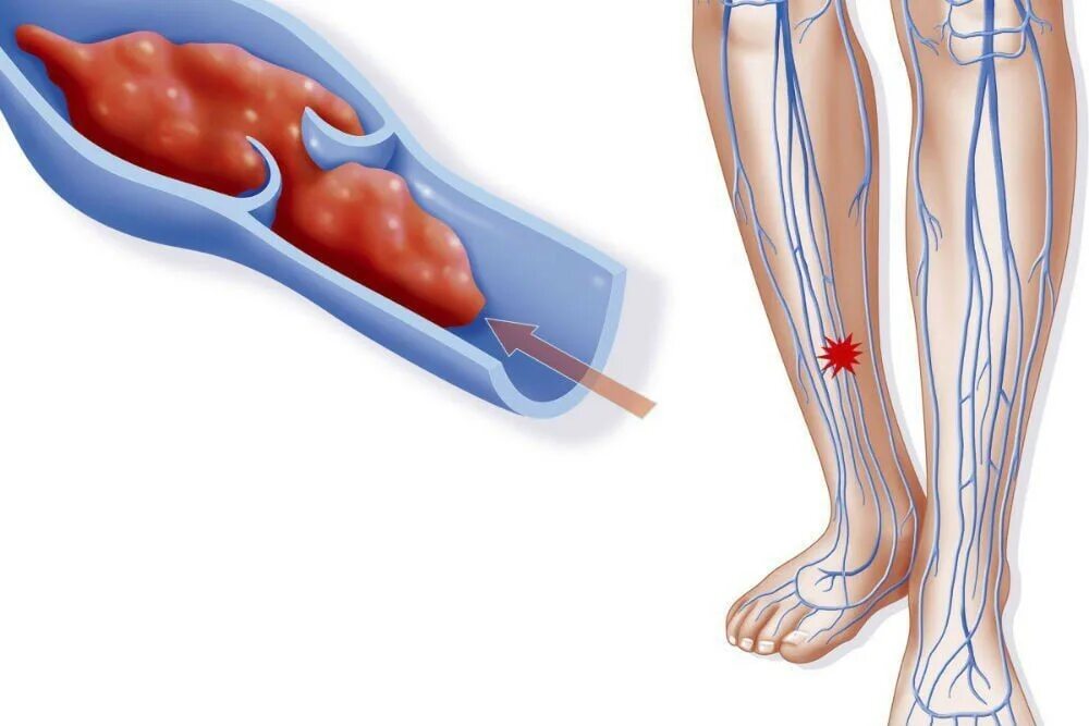 Как почистить тромбы. Флебит тромбофлебит глубоких вен. Пристеночный тромбоз БПВ.