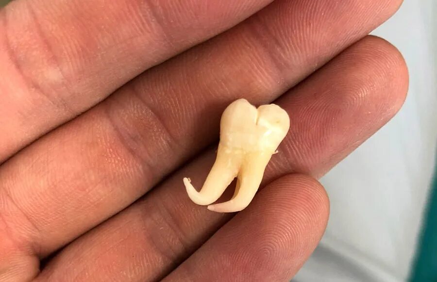 выдергивать ли коренной зуб