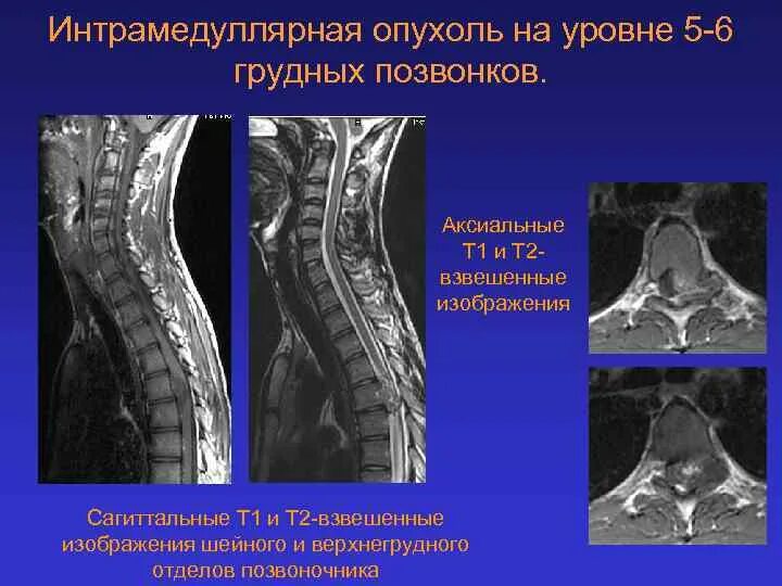 Интрамедуллярный очаг спинного мозга. Интрамедуллярная спинальная опухоль. Интрамедуллярные опухоли грудного отдела спинного мозга. Интрамедуллярная киста мрт. Интрамедуллярные опухоли спинного