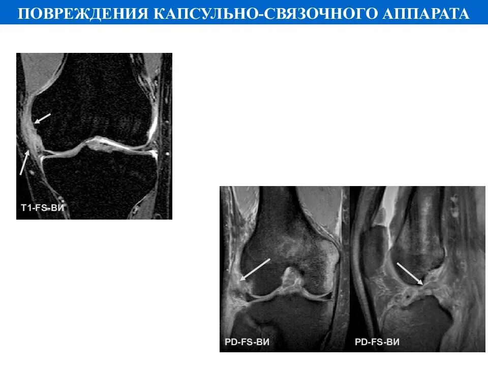 Повреждение капсульно-связочного аппарата. Частичное повреждение капсульно-связочного аппарата. Ушиб повреждение капсульно связочного аппарата. Разрыв капсульного аппарата.