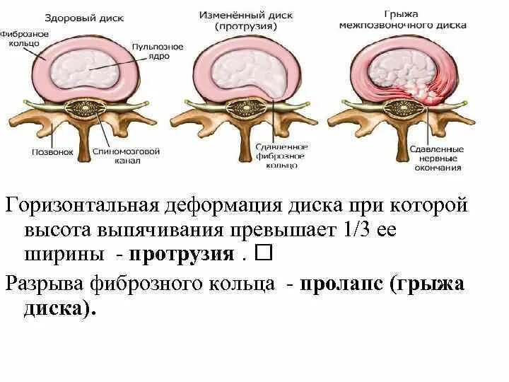 Разрыв фиброзного кольца межпозвоночного. Разрыв фиброзного кольца межпозвоночного. Фиброзное кольцо и пульпозное ядро. Разрыв фиброзного кольца межпозвоночного. Грыжа позвоночника пульпозное ядро.
