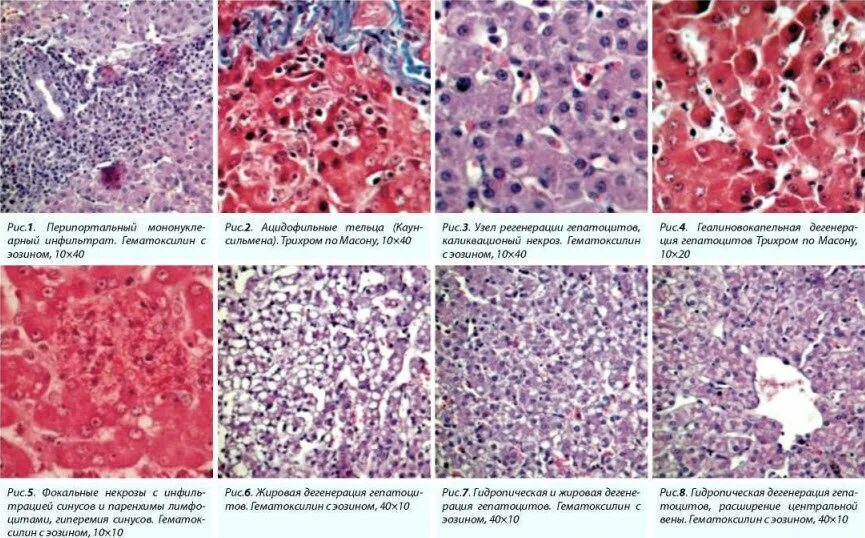 Изменение клеток печени. Некроз гепатоцитов гистология. Портальный цирроз печени микропрепарат. Фокальная нодулярная гиперплазия печени гистология. Жировой некроз гистология.