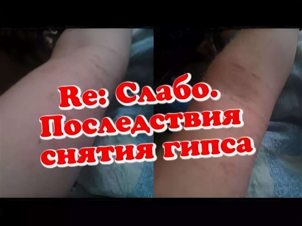 Рано снял гипс. Поздравления сняли гипс. поздравляю со снятием гипса.