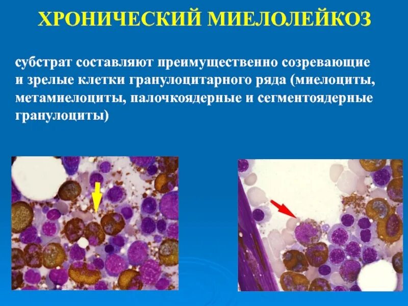 Болезнь миелолейкоз. Хронический миелолейкоз субстрат. миелолейкоз гранулоциты. хронический миелобластный лейкоз гистология.