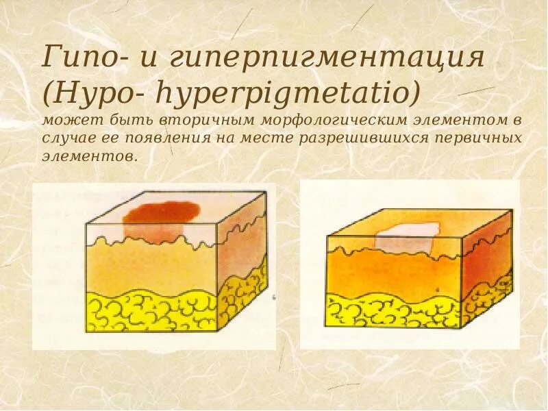 Вторичные элементы. Вторичные морфологические элементы кожи гиперпигментация. пигментация вторичные морфологический элемент на коже. вторичные морфологические элементы кожи дерматовенерология. вторичные элементы сыпи гиперпигментация.