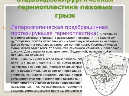 Как делается операция паховая грыжа