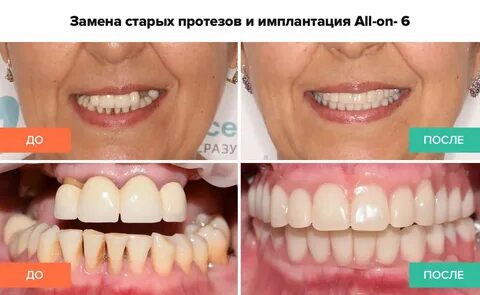 Замена имплантов отзывы