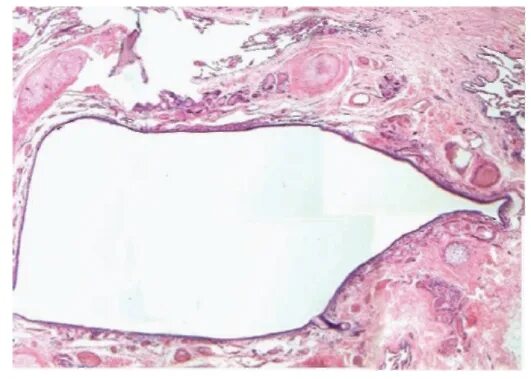 Бронхоэктазы пневмосклероз. Бронхоэктазы и пневмосклероз. Пневмосклероз макропрепарат описание. Пневмосклероз микропрепарат рисунок. Хронический бронхит с сетчатым пневмосклерозом микропрепарат.