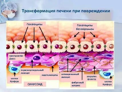 Фиброзная трансформация