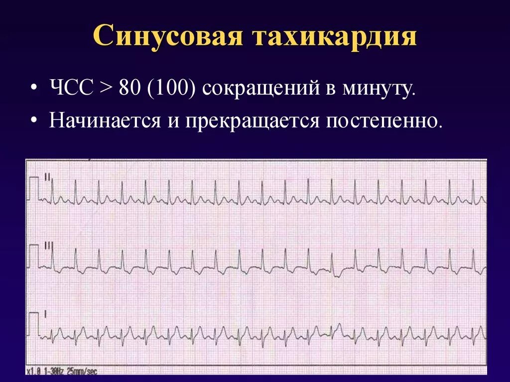 Пароксизмальная синусовая тахикардия. ЭКГ тахикардия синусовый ритм. Синусовая тахикардия ЧСС 100 ЭКГ. Синусовый ритм ЧСС 100 уд/ мин тахикардия. Признаки тахикардия у женщины симптомы