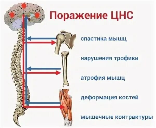 Спастика это