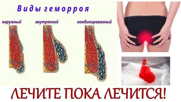 Как выглядит тромб геморрой Осложнения геморроя клиническая картина
