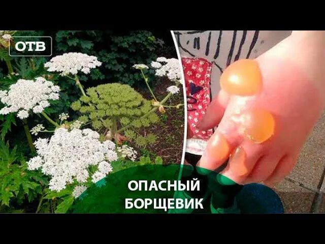 Борщевик первая помощь при ожогах. Ожог борщевиком первая помощь. Борщевик сосновского ожоги. Памятка по борьбе с борщевиком. Чем намазать ожог от борщевика.