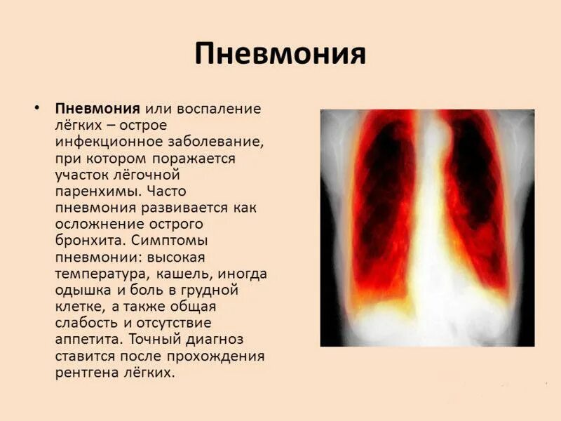 Пневмония признаки у взрослых. Пневмония симптомы. Легочные проявления пневмонии.