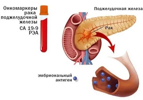 Сама 19 9. Маркеры опухоли поджелудочной железы. Онкомаркер поджелудочной железы. Карцинома поджелудочной железы нормы. Раковый маркер поджелудочной железы.