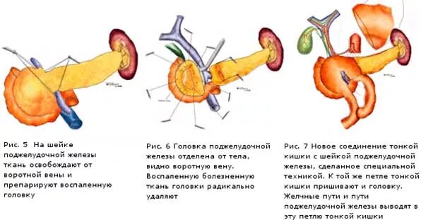 Поджелудочная железа фиброзные изменения. Операции при опухоли головки поджелудочной железы. Дистальная (левосторонняя) резекция поджелудочной железы. Дистальный отдел поджелудочной железы. T3n0m0 головки поджелудочной железы.