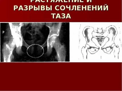 Разрыв лонного сочленения