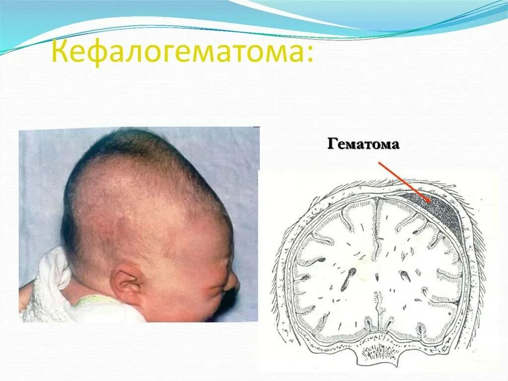 Кровоизлияние в мозг у новорожденного степени. Кефалогематома и родовая опухоль. кефалогематома теменной области. кефалогематома правой теменной кости. кефалогематома теменной кости у новорожденного.