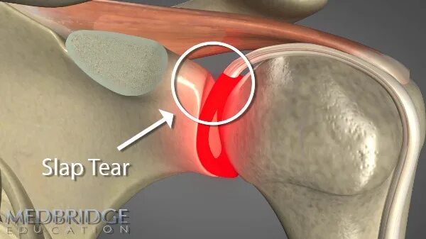 Повреждение губы плечевого сустава. Слэп синдром плечевого сустава. Slap синдром плечевого сустава. Слэп повреждение плечевого сустава.