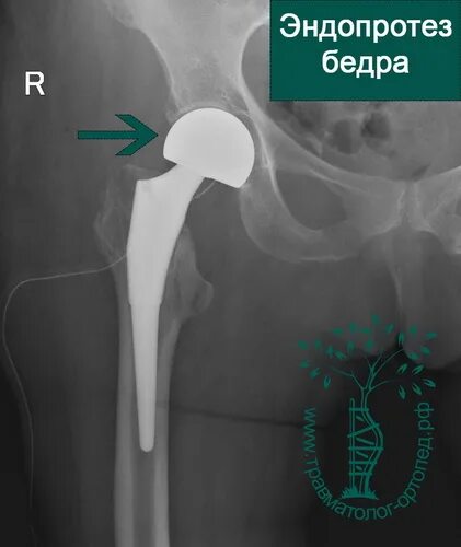 Мрт после эндопротезирования. Эндопротез тазобедренного сустава цементной фиксации. Биполярный эндопротез тазобедренного сустава. Двухполюсный эндопротез тазобедренного сустава. Smith nephew эндопротез тазобедренного сустава.