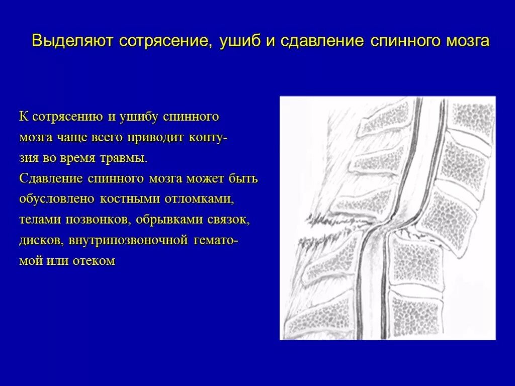 Повреждение спинного мозга. Сотрясение спинного мозга.