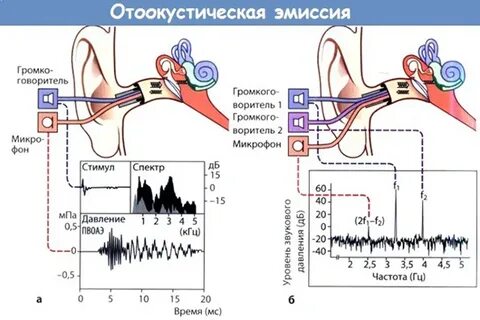 Отоакустическая эмиссия