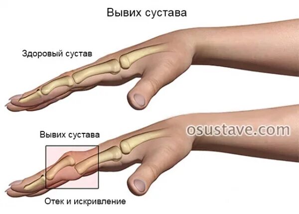Что такое полиартроз. Артроз межфаланговых суставов. Что такое полиартроз. Полиартроз межфаланговых суставов. Ревматические болезни суставов.