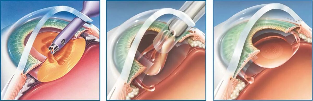 Факоэмульсификация катаракты с имплантацией. Факоэмульсификация катаракты этапы операции. Факоэмульсификация катаракты с имплантацией интраокулярной линзы. Замена хрусталика что нельзя делать после операции