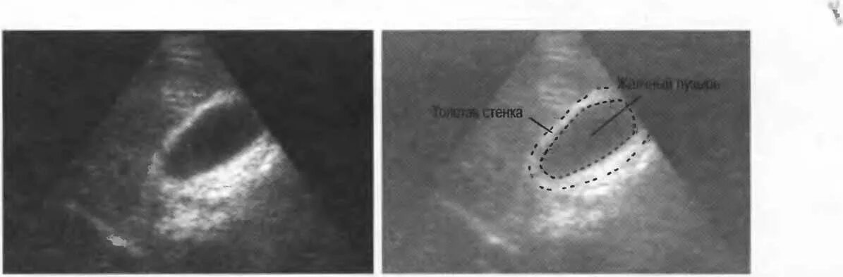Изменение стенок желчного пузыря. Холестероз желчного пузыря. Кальциноз желчного пузыря кт. Утолщение стенок желчного пузыря. Двойной контур желчного пузыря УЗИ.