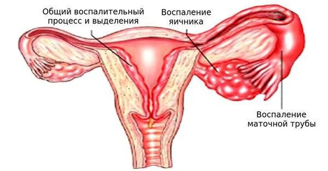 Сальпингоофорит (аднексит). Хронический двухсторонний сальпингоофорит. Подострый сальпингоофорит. Послеродовый сальпингоофорит симптомы. Аднексид