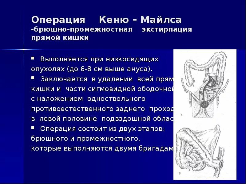 Операции через прямую кишку. Брюшно-промежностная экстирпация (операция Кеню-Майлса). Операция Кеню-Майлса брюшно-промежностная. Брюшно-промежностная экстирпация прямой кишки. Брюшнопроменостная экстирпация прямой уишкм.