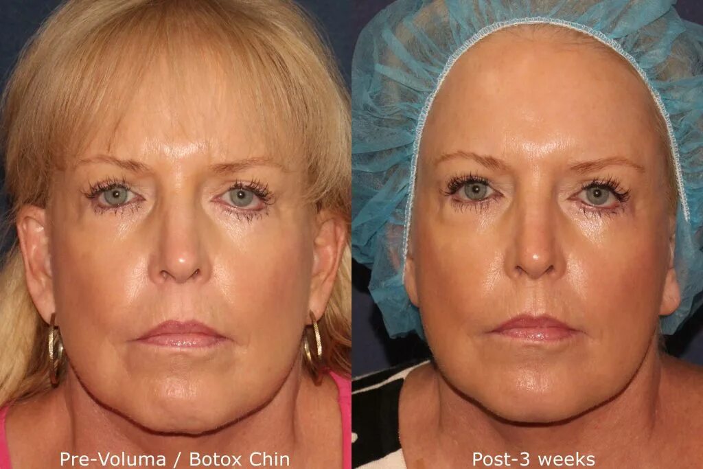Juvéderm Voluma Dermal Filler San Diego, CA CLDerm