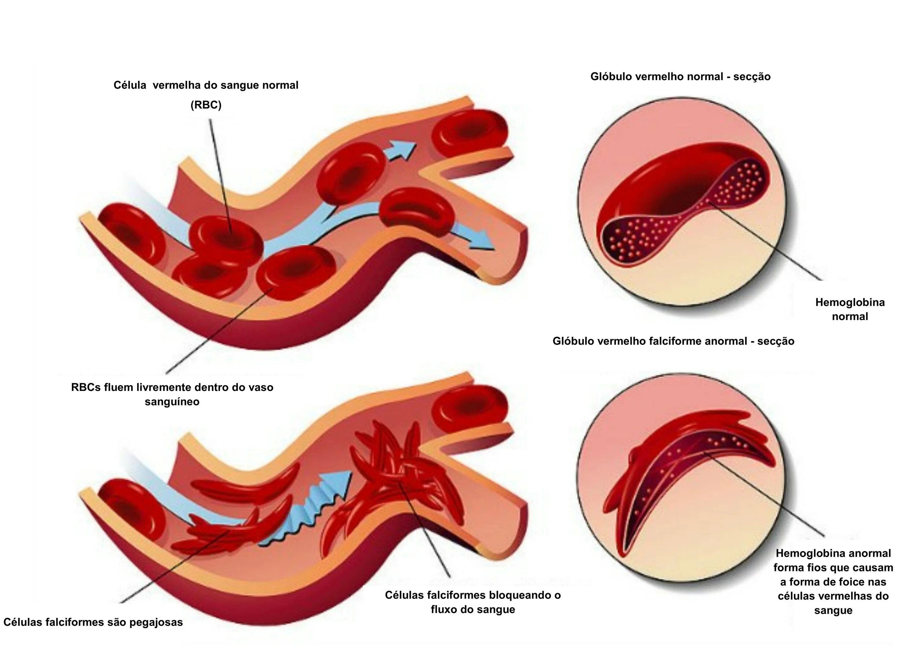 Серповидноклеточная анемия формы. Серповидно клеточная анемия. Форма эритроцитов при серповидноклеточной анемии. При серповидно-клеточной анемии гемоглобин:. Серповмдно клеточная анемия.