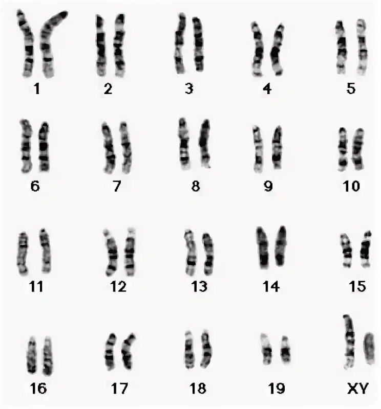 Сколько хромосом у кошки. Ахондроплазия кариотип. Хондродистрофия кариотип. Кариотип детей с синдромом Вильямса. Полиморфизм хромосом.