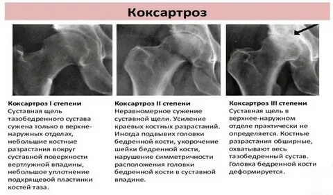 Препараты для лечения коксартроза 2 степени