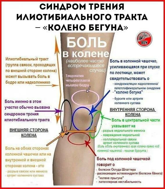 Неприятные ощущения в колене. Болит колено сбоку с внутренней стороны при. синдром идиоьибиального тракта. синдром трения илиотибиального тракта в колене. болят колени при приседании.