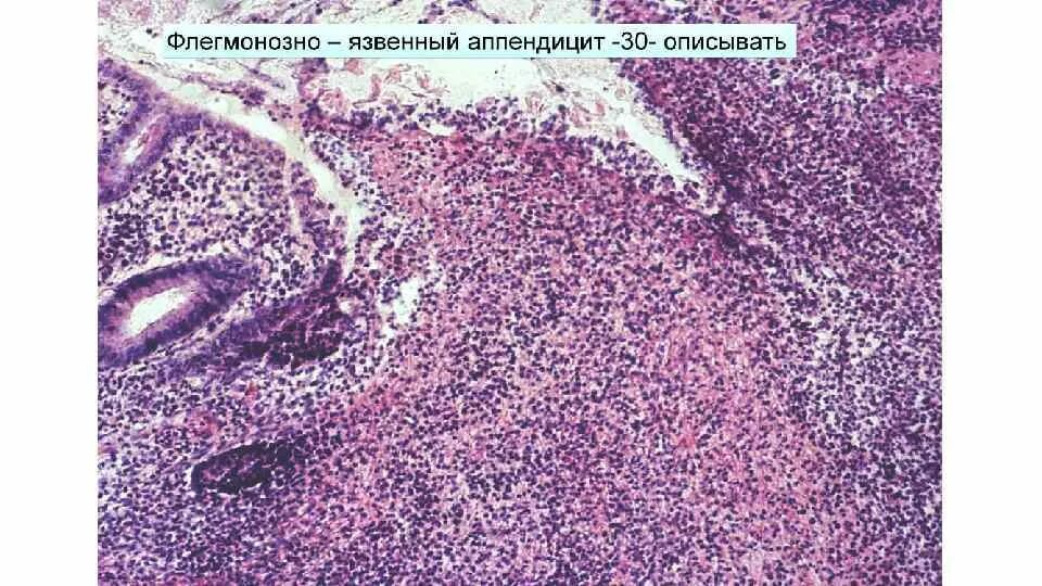 Флегмонозный аппендицит микропрепарат патанатомия. Флегмонозно язвенный аппендицит микропрепарат. Флегмонозный аппендицит патологическая анатомия. Флегмонозно язвенный холецистит микропрепарат.