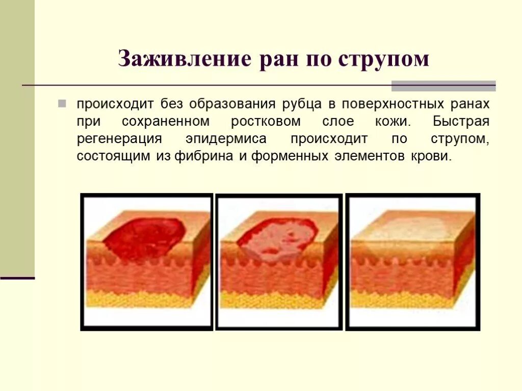 Слизистая рубца. Заживление раны под струпом. Процесс заживления раны под струпом. Ссадина стадии заживания.