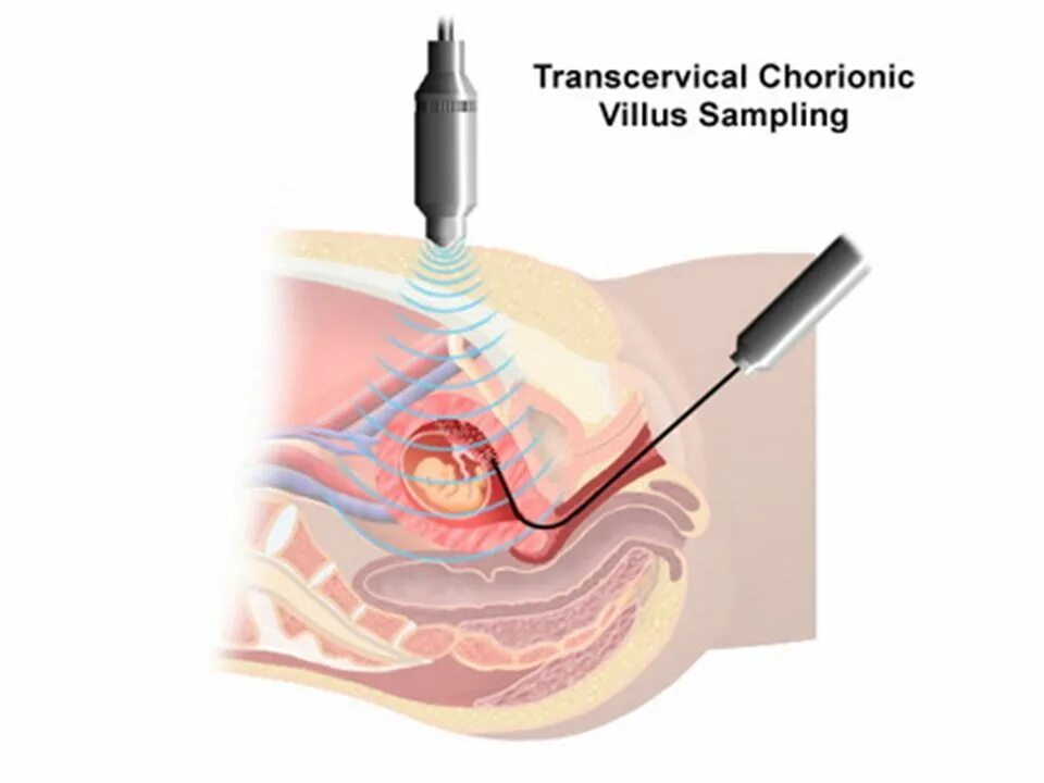 Трансабдоминальная биопсия ворсин хориона. Пренатальная диагностика биопсия хориона. Трансцервикальная биопсия ворсин хориона. Биопсия хориона амниоцентез кордоцентез. Инвазивный тест при беременности