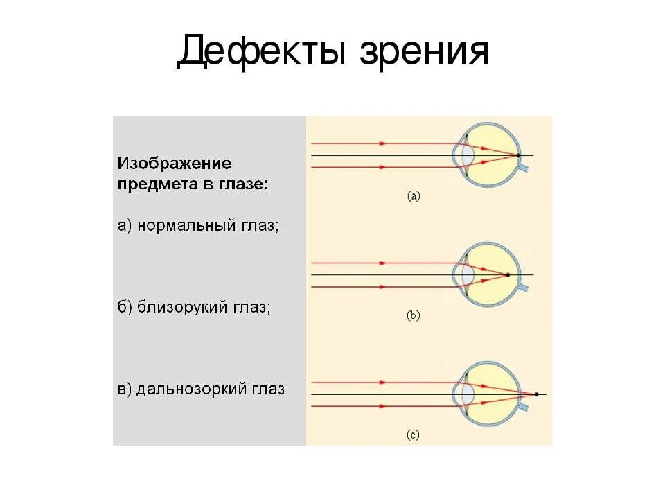 Дополните предложения изображение в близоруком