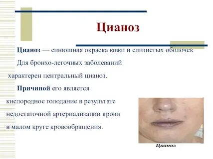 Синюшный оттенок слизистых