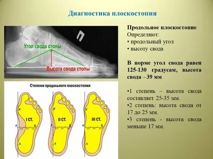 Сколиоз стельки