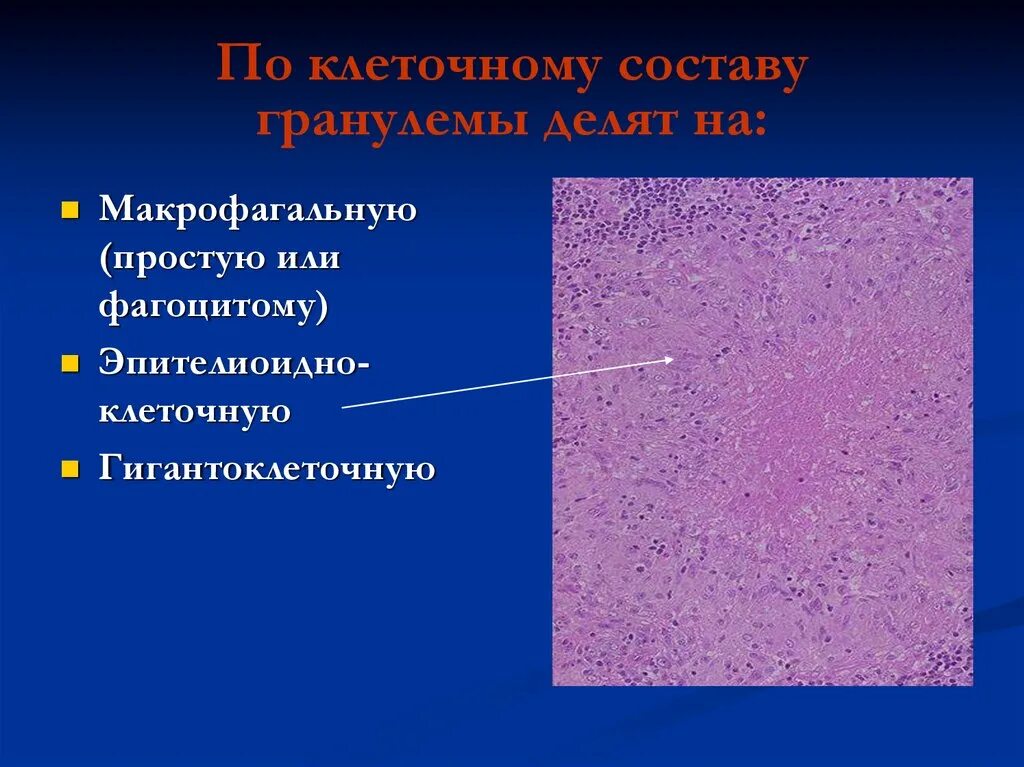 Эпителиоидная гранулема. Некроз гистология клетки. Клеточная гранулема. Клеточная гранулема. Туберкулезная гранулема клетки.