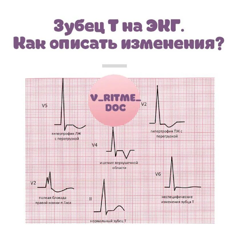 Инверсия зубца т. Экг высокий зубец т v2-v4. увеличение зубца т. инверсия зубца т на экг. сглаженный зубец т на экг.