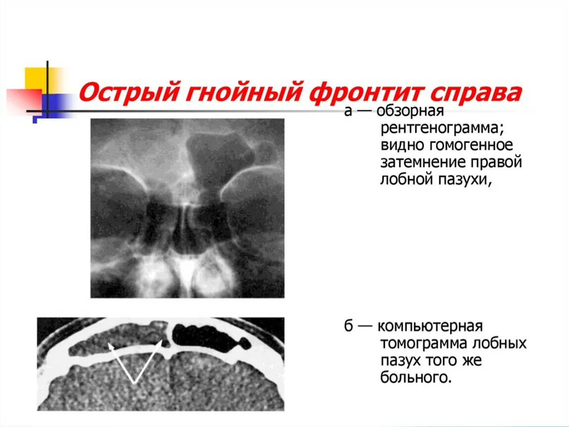 Острый левосторонний Гнойный фронтит рентгенография. Острый правосторонний Гнойный фронтит. Острый фронтит симптомы. Острый Гнойный фронтит справа..