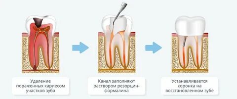 Удаление коронковой пульпы