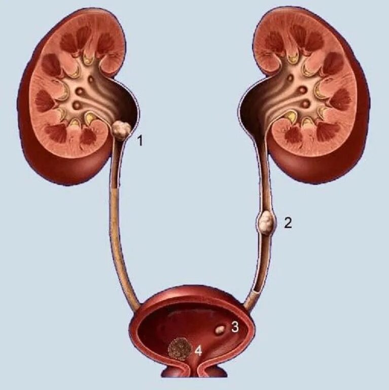 Мочекаменная болезнь мочеточника. Камни в почках мочеточнике и мочевом пузыре. Камень мочевой пузырь мочеточник почка камни\. Мочекаменная болезнь. Обструкция мочеточника. В почечных лоханках собирается